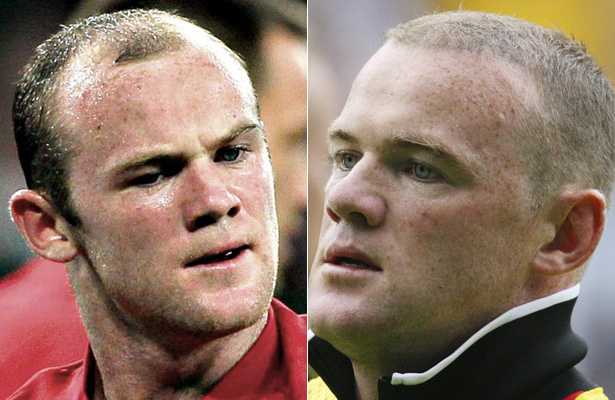 Wayne Rooney around the time of his hair transplant
