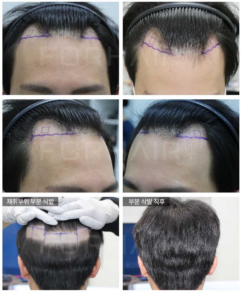 20s-950grafts-before-after1