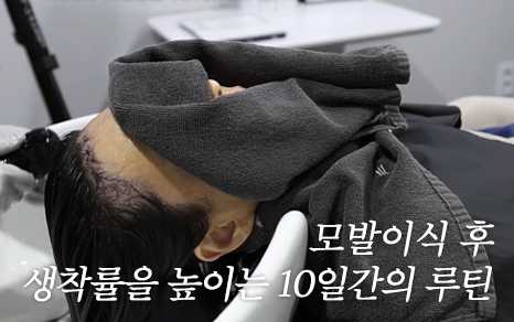 hair shampoo after hair transplant