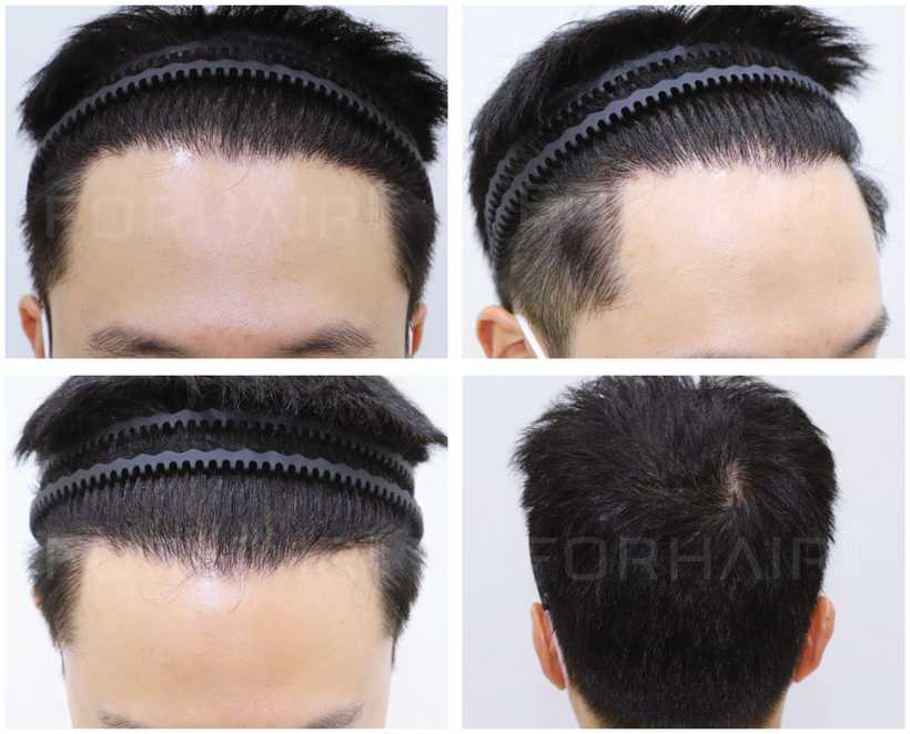 30s-2000grafts-before-after4