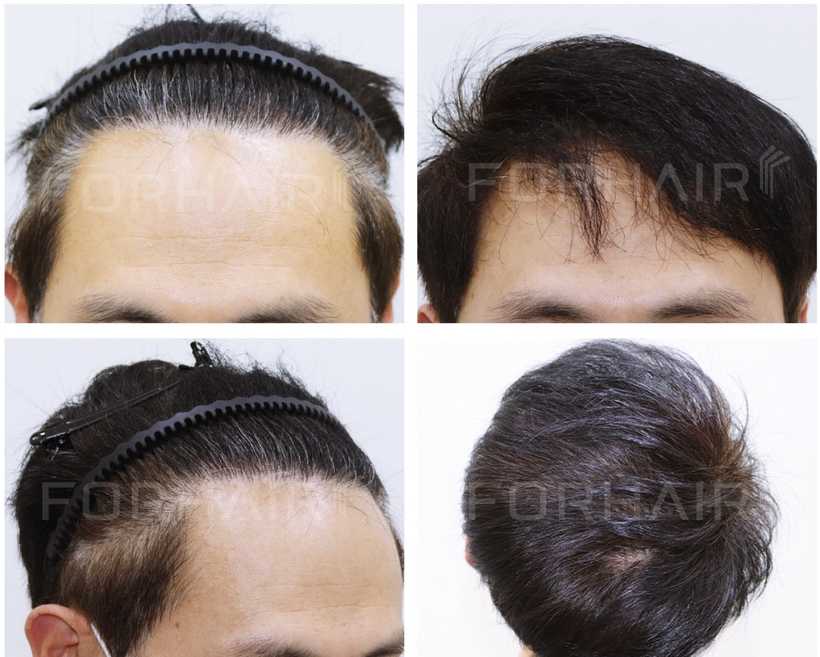 50s-2300grafts-before-after5