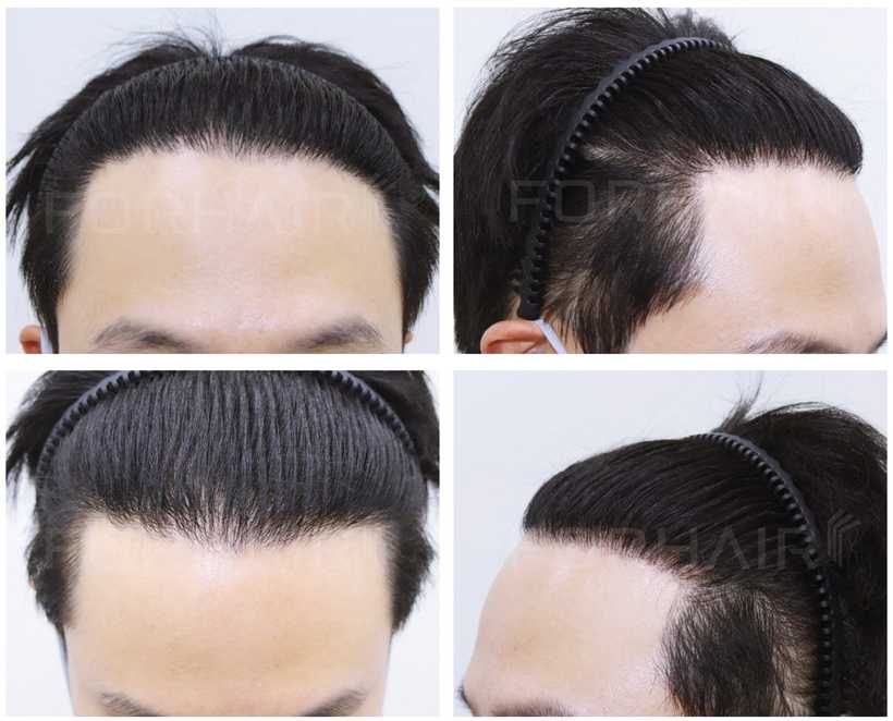 30s-2000grafts-before-after5