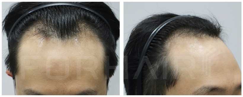 30s-2000grafts-before-after1