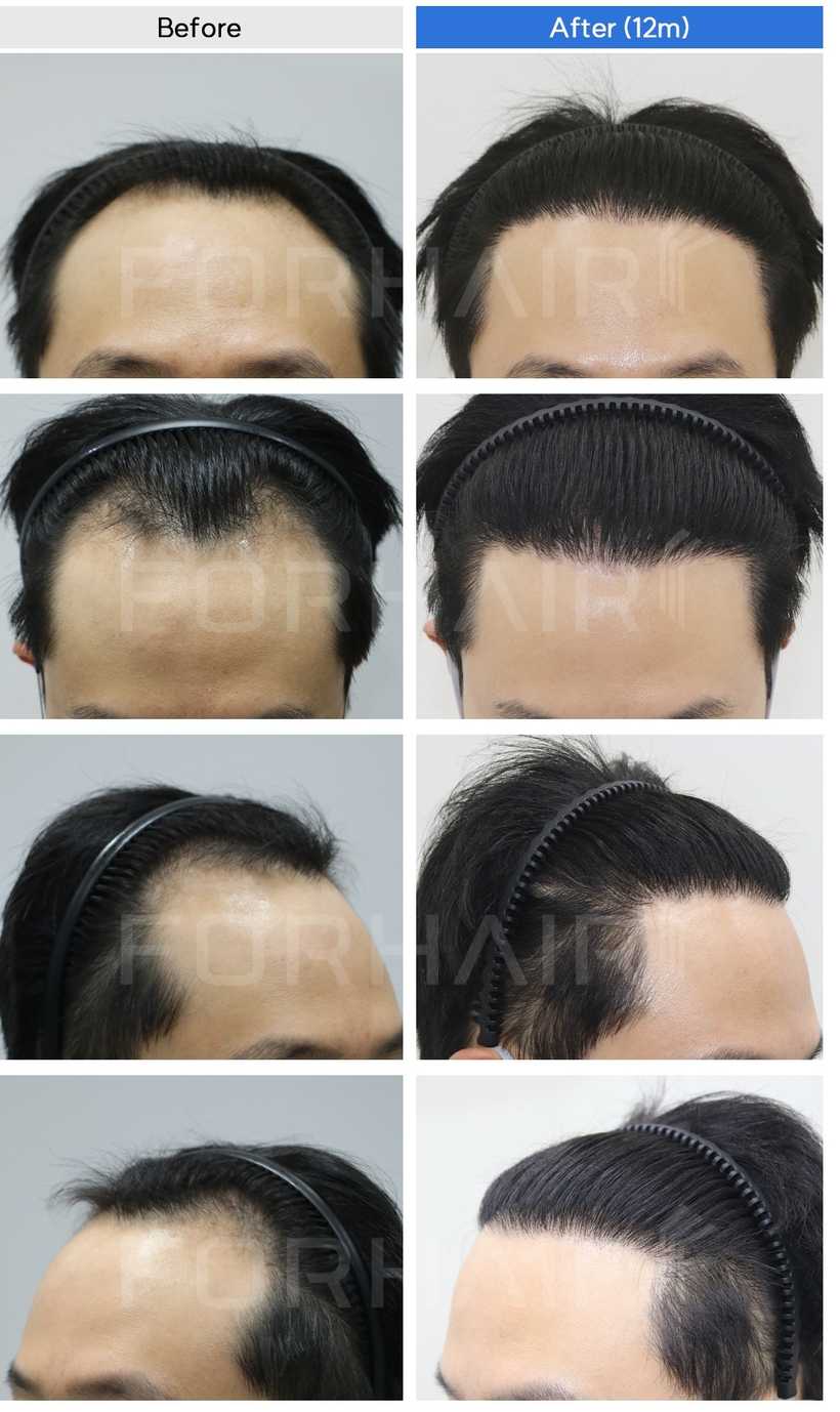 30s-2000grafts-before-after