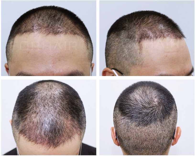 30s-2000grafts-before-after3