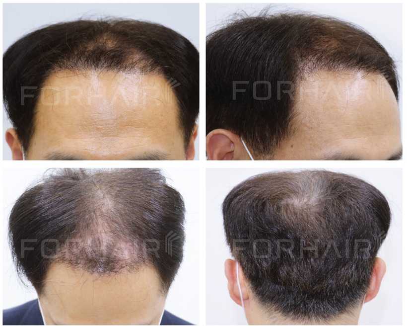 50s-2300grafts-before-after3