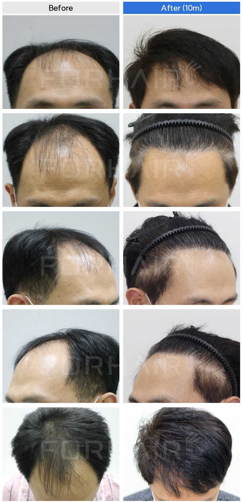 50s-2300grafts-before-after