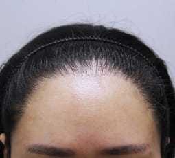 bad hairline case - poly follicles1