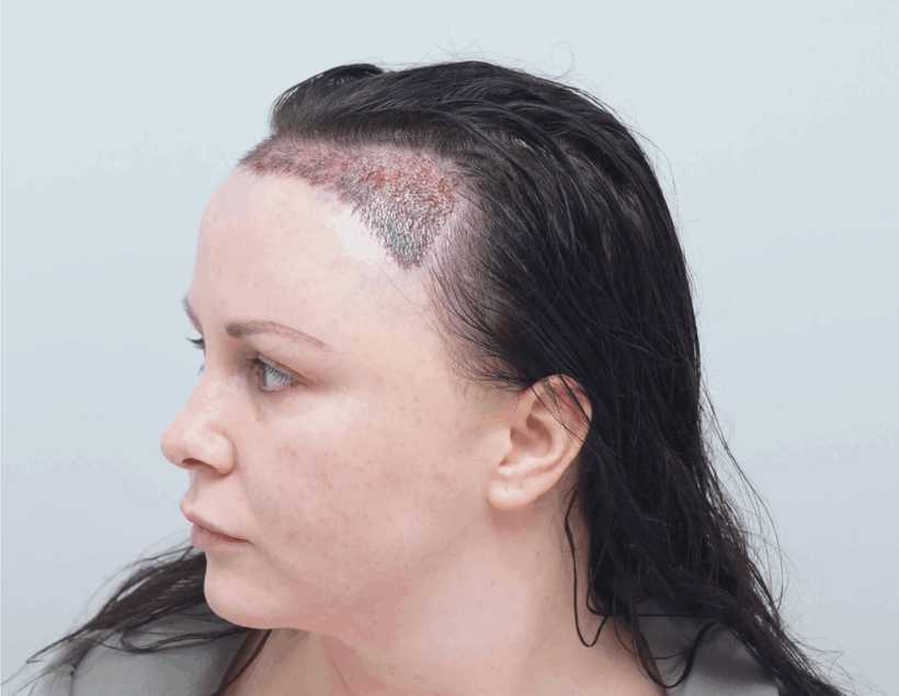 Chanelle Hayes showing her hairline shortly after transplantation