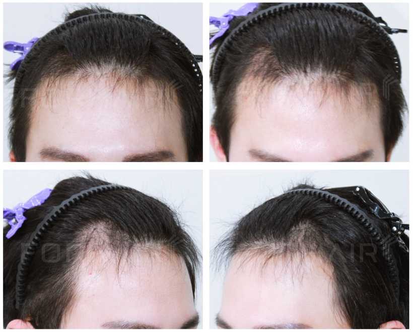 20s-950grafts-before-after3