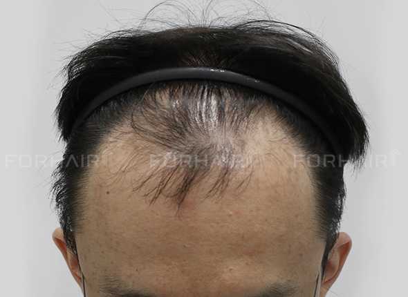 Hair Loss image