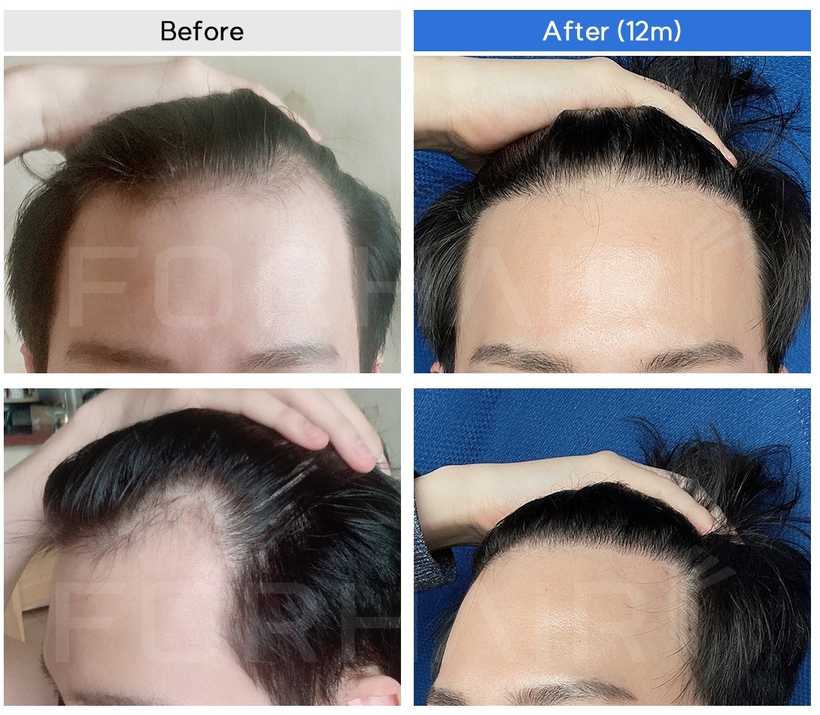 20s-950grafts-before-after