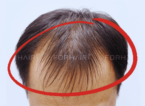 M hair loss hair-loss-hairline