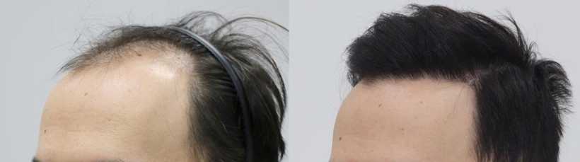 hair transplant before after image