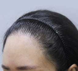 bad hairline case - poly follicles2