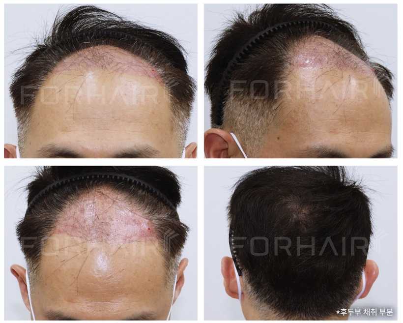 50s-2300grafts-before-after2