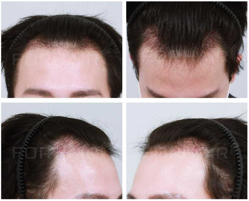 20s-950grafts-before-after2