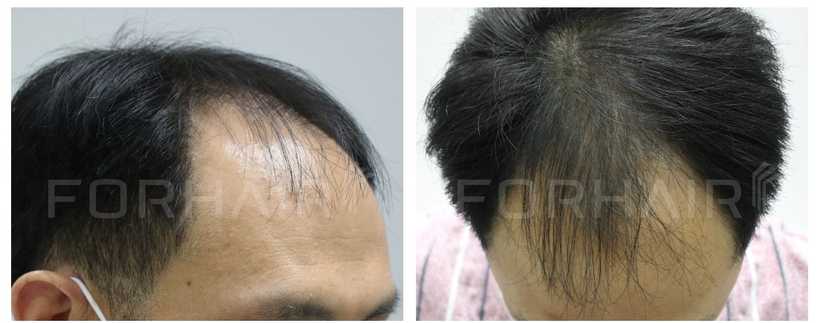 50s-2300grafts-before-after1