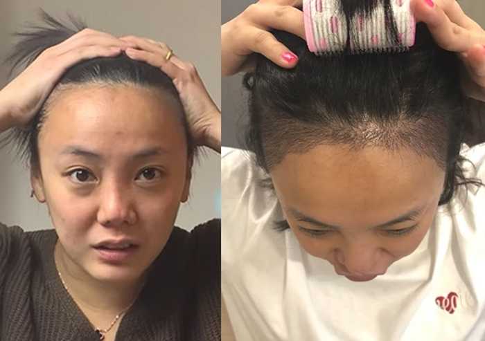 Go Eun-ah's hairline before and after transplantation