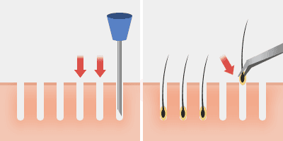 slit-forceps