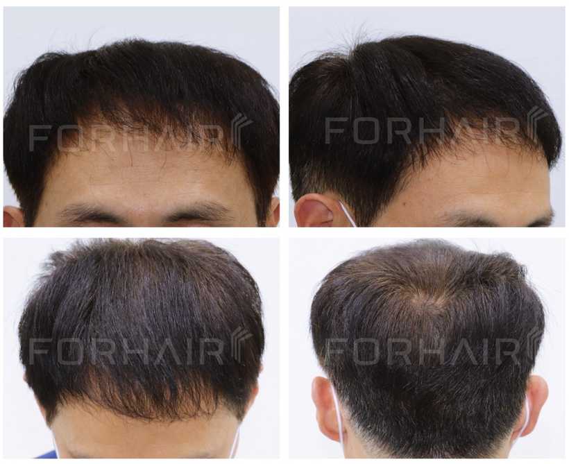 50s-2300grafts-before-after4