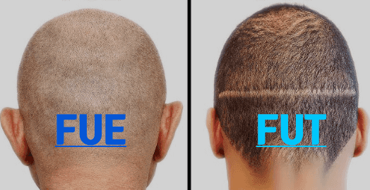 FUE vs FUT