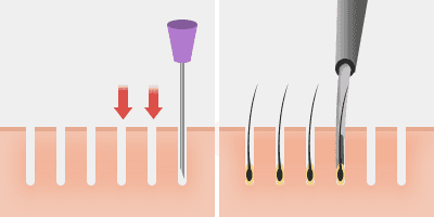 slit-implanter