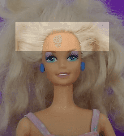 An unnatural hairline can result in a doll-like appearance. Follicle isolation