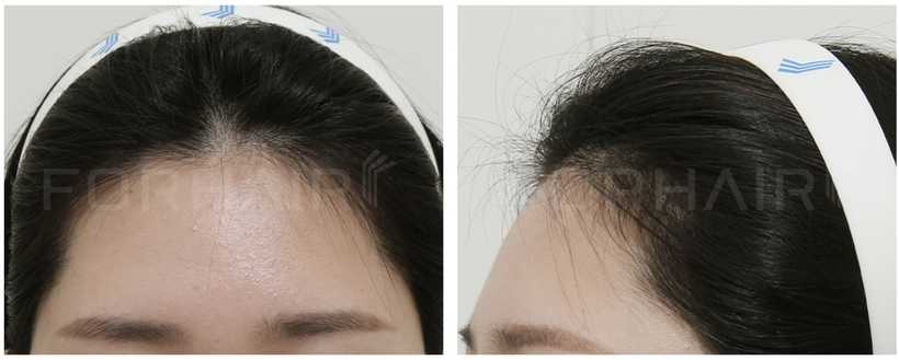 20s-364g-before-after6