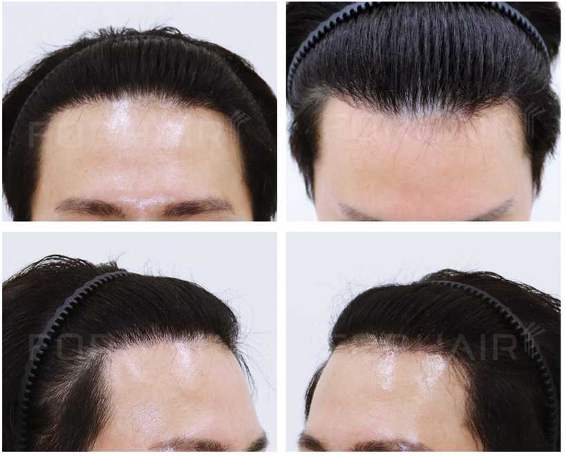 20s-950grafts-before-after4